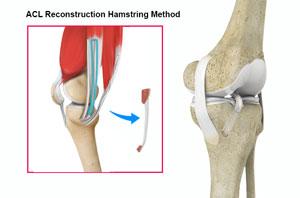 ACL Reconstruction