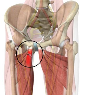 Adductor Tendon Repair