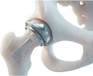 Ceramic-on-Ceramic Hip Resurfacing