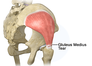 Gluteus Medius Repair