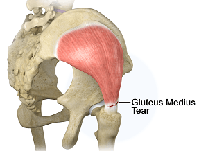 Gluteus Medius Repair 