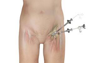 Hip Arthroscopy