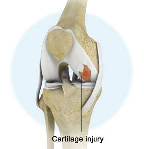 Knee Cartilage Injuries