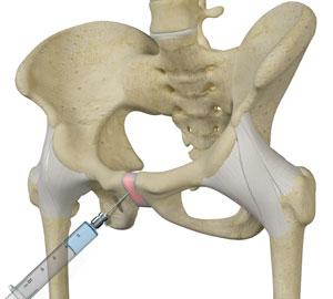 Groin Repair