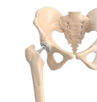 Advanced Hip Replacement