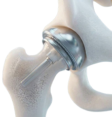 Ceramic-on-Ceramic Hip Resurfacing