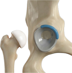 Hip Preservation