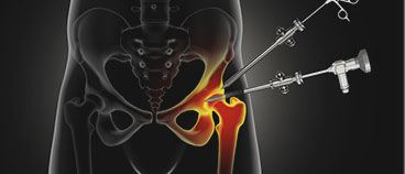 Hip Preservation Surgeries
